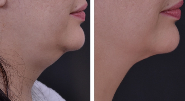 before & after photo of Rhinoplasty