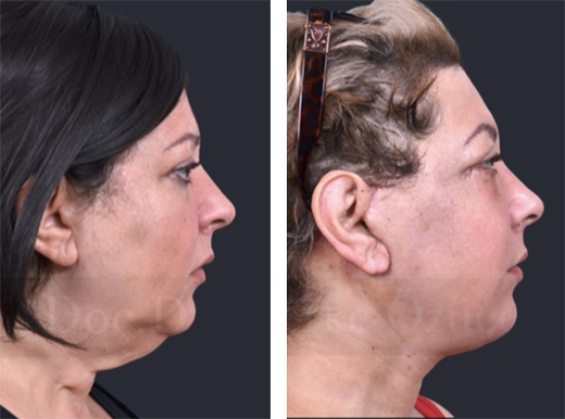 before & after photo of neck-lift