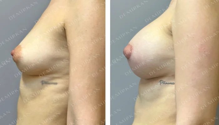 before & after photo of Nipple/Areola Reduction