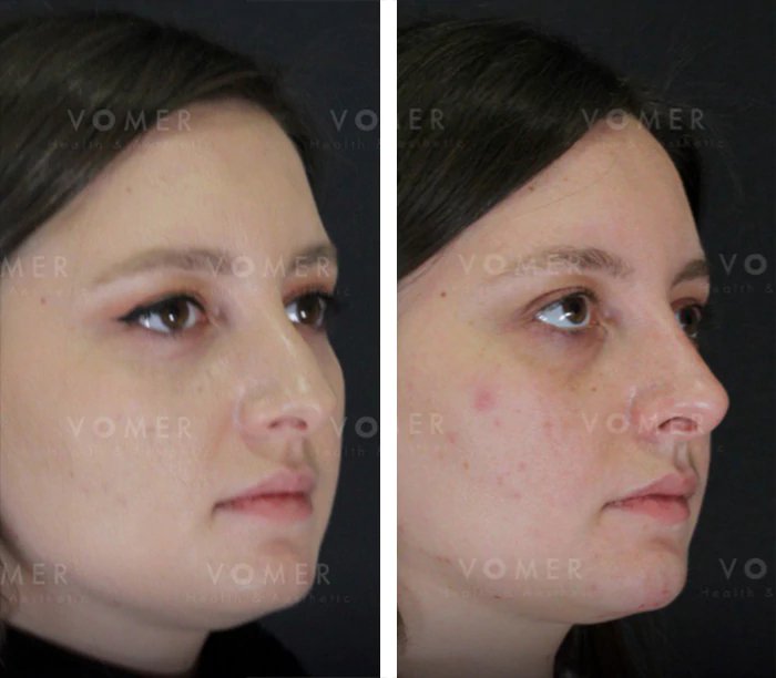 before & after photo of Rhinoplasty