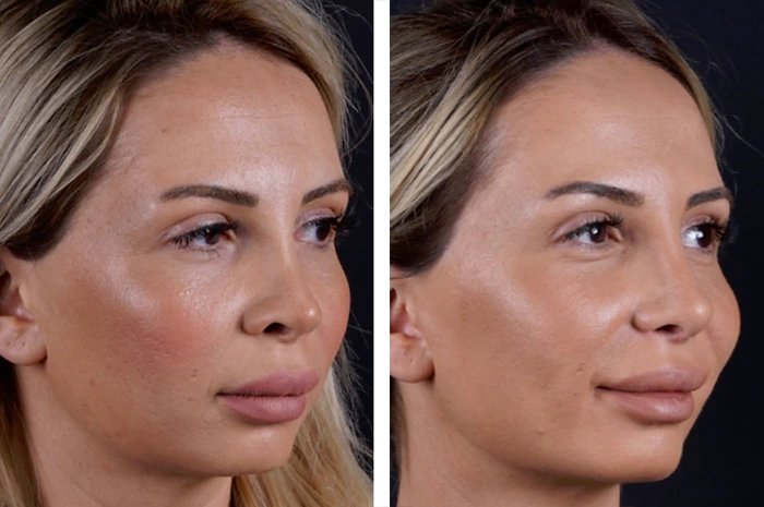 before & after photo of عملية تجميل الأنف