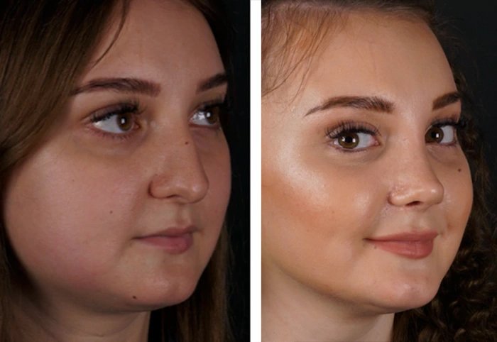 before & after photo of Rhinoplasty