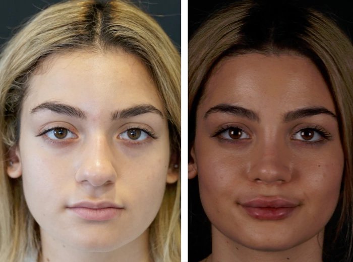 before & after photo of Rhinoplasty