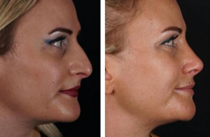 before & after photo of عملية تجميل الأنف