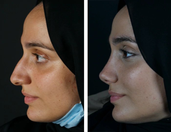 before & after photo of عملية تجميل الأنف