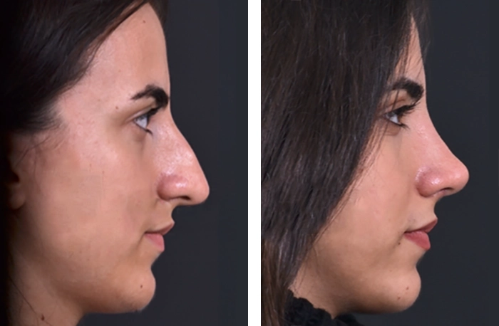 before & after photo of Rhinoplasty