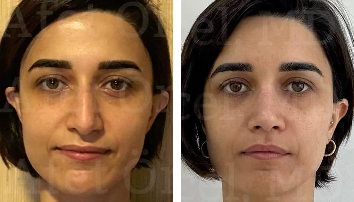 before & after photo of عملية تجميل الأنف