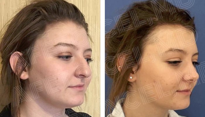 before & after photo of Rhinoplasty