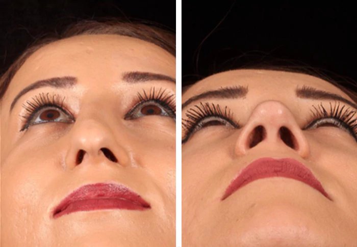 before & after photo of Rhinoplasty