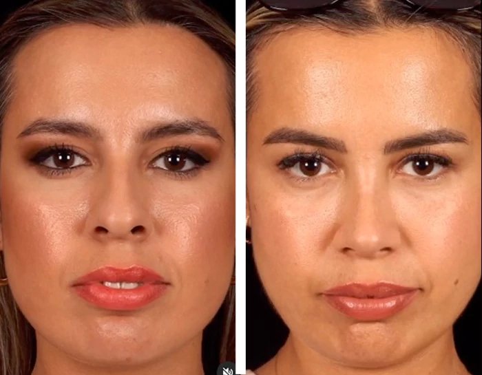 before & after photo of عملية تجميل الأنف