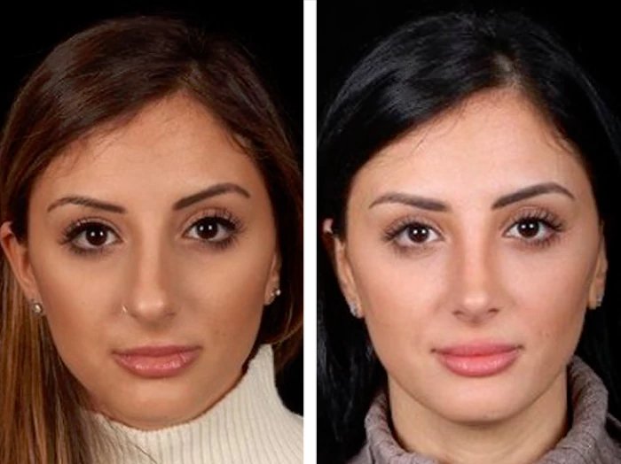 before & after photo of عملية تجميل الأنف