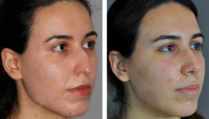 before & after photo of عملية تجميل الأنف