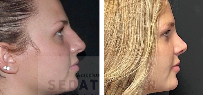 before & after photo of Eyelid Surgery