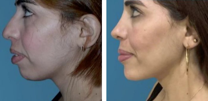 before & after photo of عملية تجميل الأنف