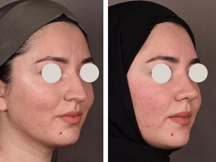 before & after photo of عملية تجميل الأنف