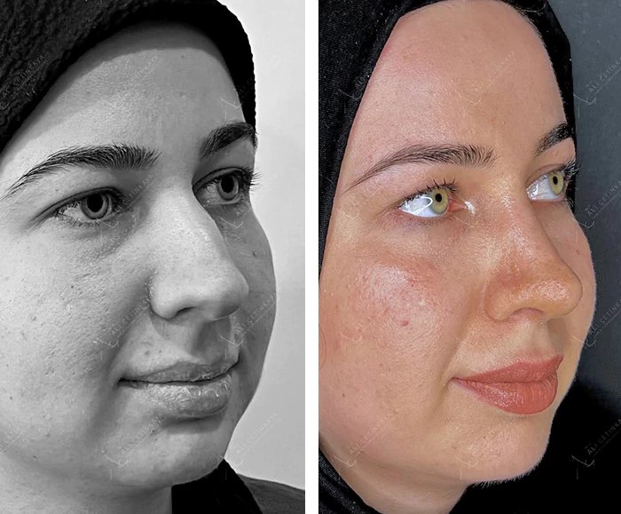 before & after photo of Rhinoplasty