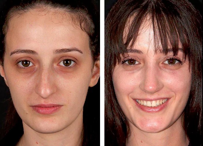 before & after photo of Rhinoplasty