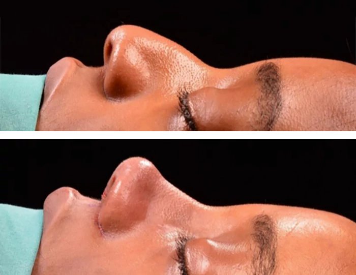 before & after photo of Rhinoplasty