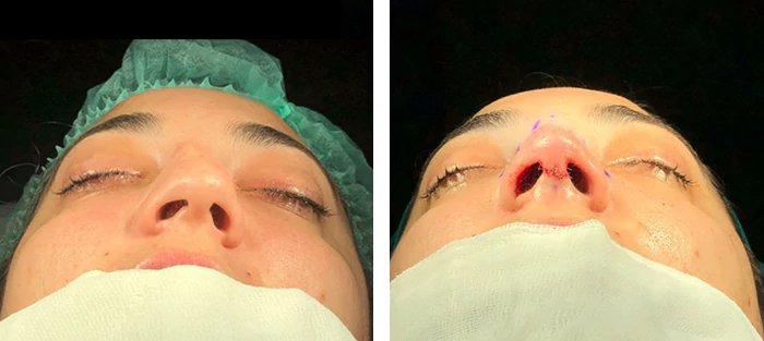 before & after photo of عملية تجميل الأنف