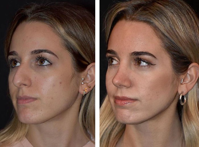 before & after photo of Rhinoplasty