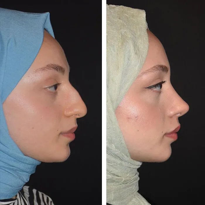 before & after photo of Rhinoplasty