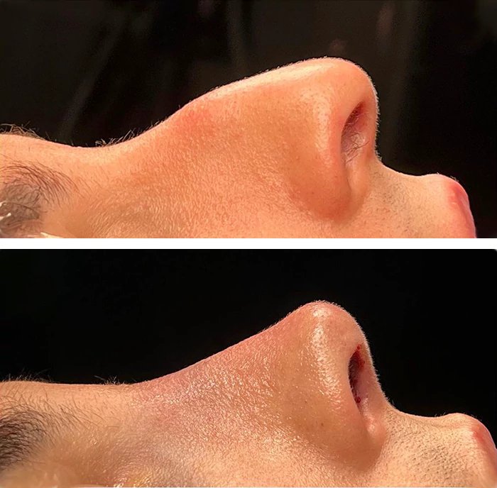 before & after photo of Rhinoplasty