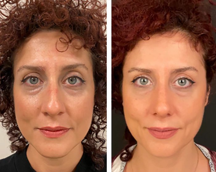 before & after photo of عملية تجميل الأنف