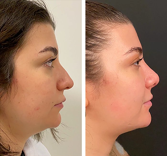 before & after photo of Rhinoplasty