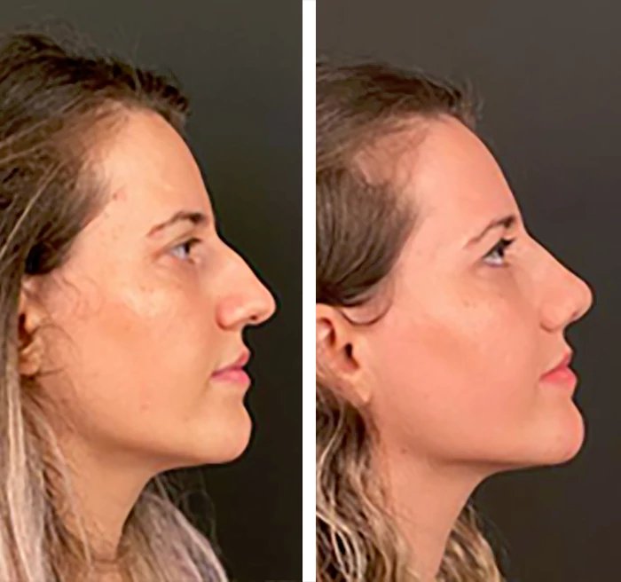 before & after photo of Rhinoplasty