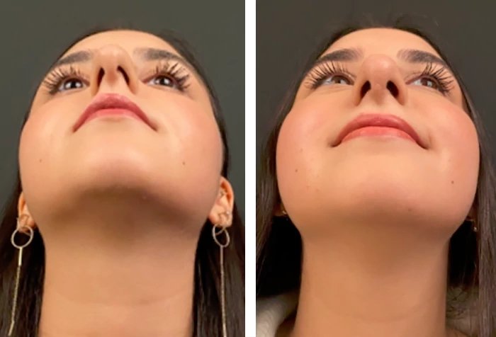 before & after photo of Rhinoplasty