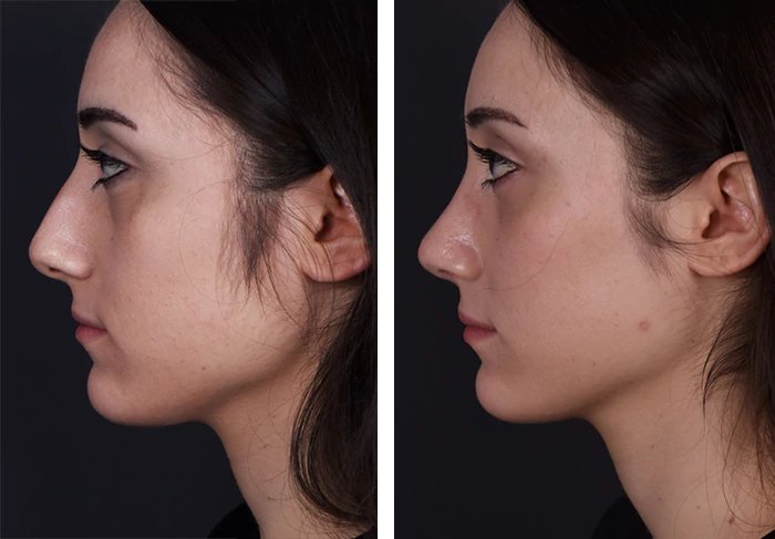 before & after photo of Rhinoplasty