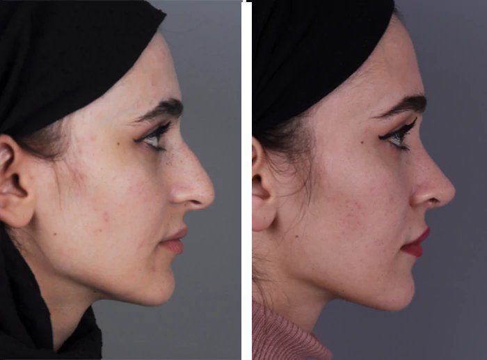 before & after photo of عملية تجميل الأنف