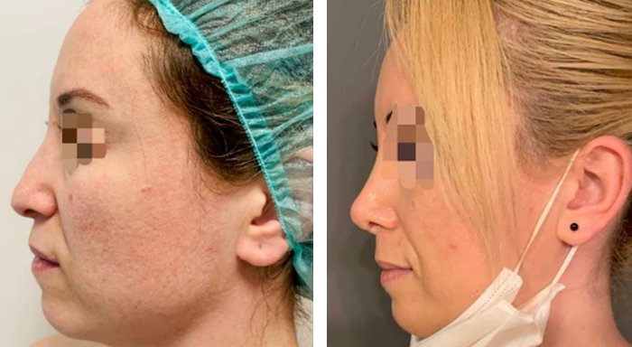 before & after photo of Rhinoplasty