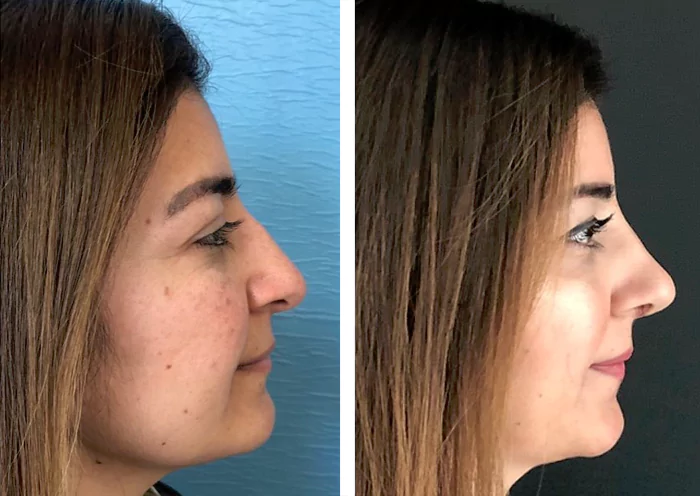 before & after photo of Rhinoplasty