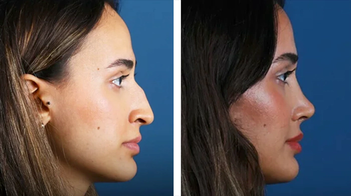 before & after photo of Rhinoplasty