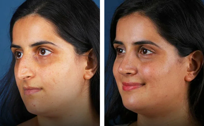 before & after photo of عملية تجميل الأنف