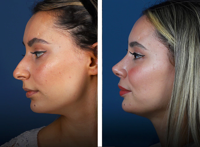 before & after photo of Rhinoplasty