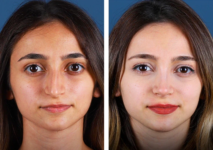 before & after photo of عملية تجميل الأنف