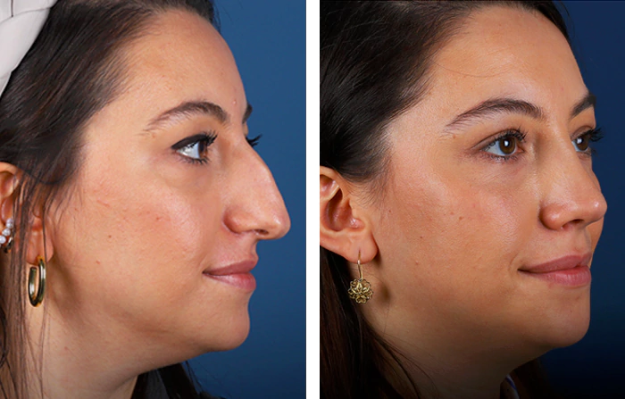 before & after photo of Rhinoplasty