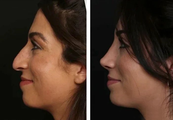 before & after photo of عملية تجميل الأنف