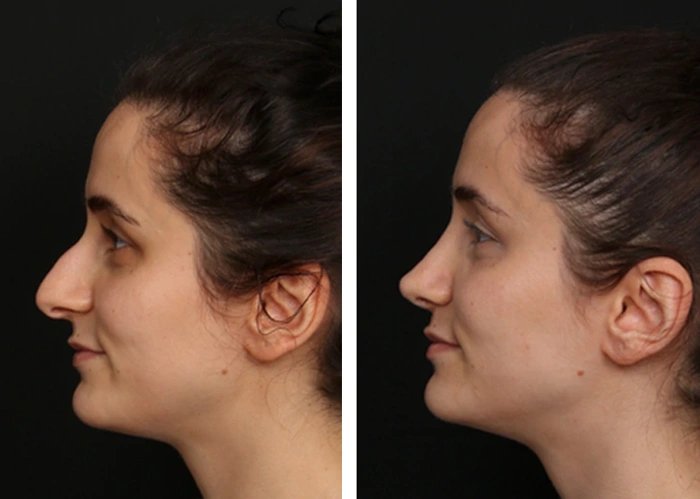 before & after photo of Rhinoplasty