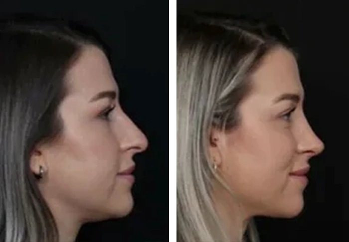 before & after photo of Rhinoplasty