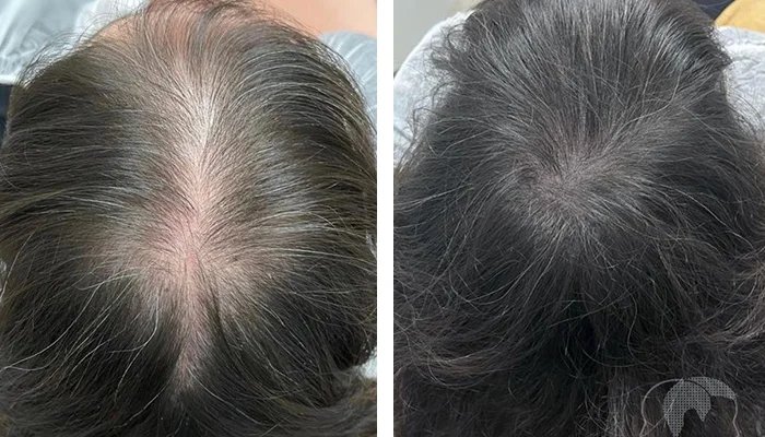 before & after photo of micropigmentation