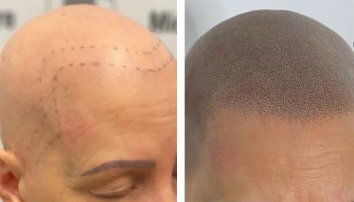 before & after photo of Micropigmentation