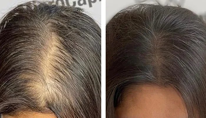 before & after photo of micropigmentation
