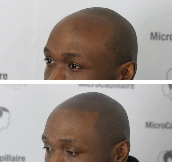 before & after photo of Micropigmentation