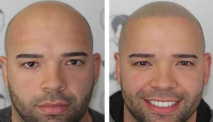 before & after photo of التصبغ الدقيق