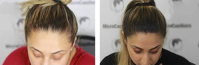 before & after photo of التصبغ الدقيق