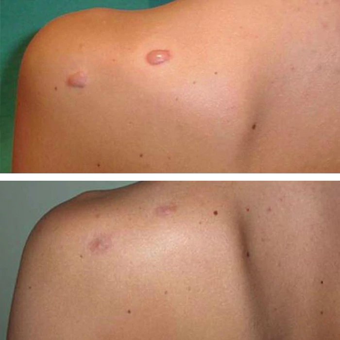 before & after photo of Scar Revision