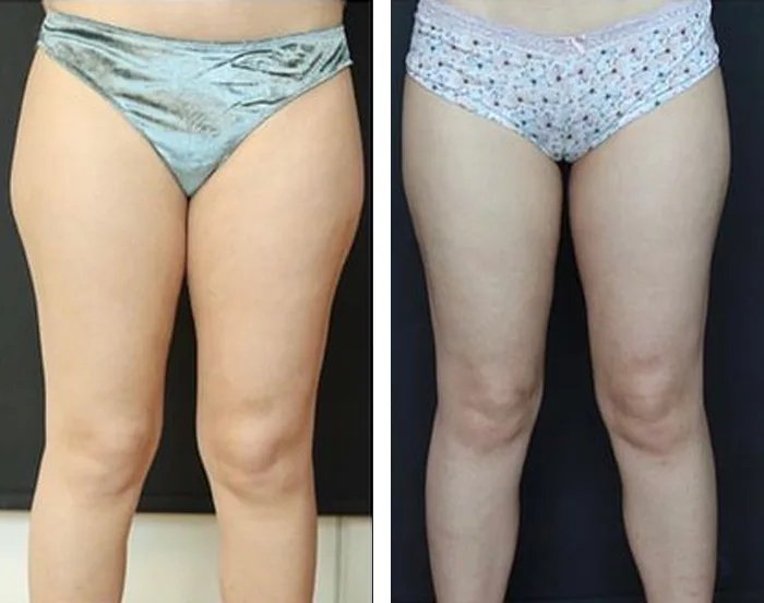 before & after photo of Thigh Lift